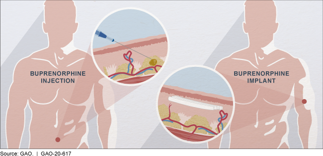 figure of injections, implants