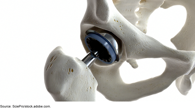 3D rendering of a hip implant